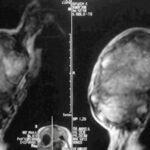 Condrosarcoma esternón