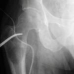 Condrosarcoma cadera - rescate con prótesis tumoral