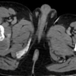 Condrosarcoma cadera - rescate con prótesis tumoral