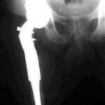 Condrosarcoma cadera - rescate con prótesis tumoral