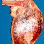 Osteosarcoma tibia