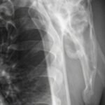Condrosarcoma escápula