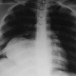 TCG recurrencia tumoral y metástasis pulmonares