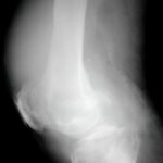Condrosarcoma de fémur distal