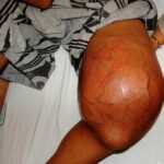 Foto clínica de osteosarcoma