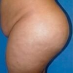 Osteocondromatosis múltiple