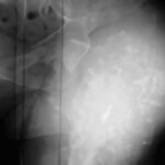 Osteocondromatosis múltiple