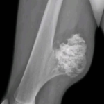 Osteocondroma en fémur