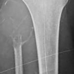 Tumor de células gigantes peroné derecho