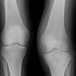 Condroblastoma en la tibia izquierda