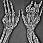 Encondromatosis