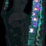 Metástasis en columna
