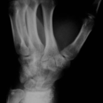 Osteosarcoma del radio distal izquierdo