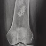 RX Condrosarcoma en fémur