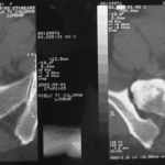Osteocondroma en columna