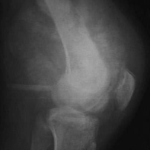 Osteosarcoma de rodilla