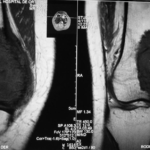 Resonancia magnética en tumor de células gigantes