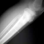 Osteosarcoma tibia derecha