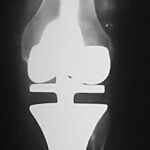 Osteosarcoma de tibia derecha - rescate con prótesis tumoral