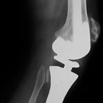 Osteosarcoma de tibia derecha - rescate con prótesis tumoral