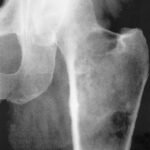 Condrosarcoma de cadera izquierda