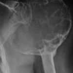 Tumor células gigantes en húmero proximal izquierdo