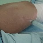 Biopsia transoperatoria por aspiración y con aguja