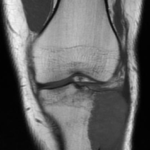 Tumor de células gigantes en la tibia