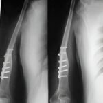 Reconstrucción con peroné vascularizado ipsilateral centralizado