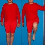 Reconstrucción con peroné vascularizado ipsilateral centralizado