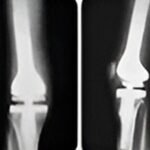 9.2 Condrosarcoma fémur distal - rescate con protesis tumoral