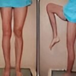 Condrosarcoma fémur distal - rescate con protesis tumoral copia