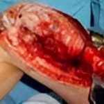 Condrosarcoma fémur distal - rescate con protesis tumoral