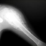 Osteosarcoma hombro