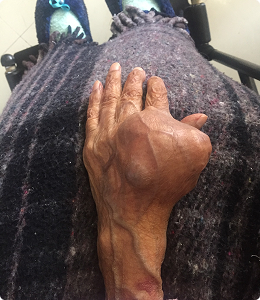 Imagen clínica de condrosarcoma