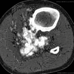 Seguimiento osteosarcoma de peroné con reconstrucción microvascularizada