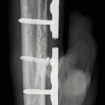 Seguimiento osteosarcoma de peroné con reconstrucción microvascularizada(