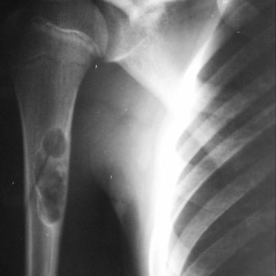 Defecto fibroso fracturado