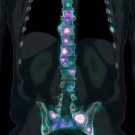 Metástasis en columna