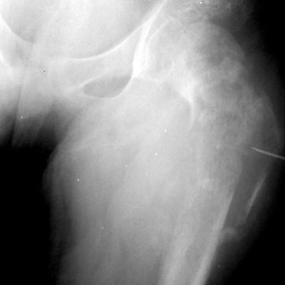 Osteosarcoma en la cadera izquierda